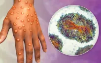 Thái Lan xác nhận bệnh nhân mắc đậu mùa khỉ ở nước này là do chủng Clade 1b