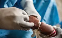 WHO cảnh báo về sự lây lan của bệnh đậu mùa khỉ