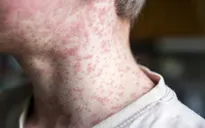 Mỹ báo cáo ca tử vong do bệnh sởi đầu tiên sau 10 năm