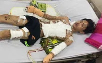 Nam sinh ở Quảng Bình mất bàn tay, nguy kịch vì tự chế pháo nổ