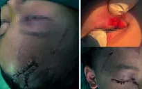 Nghệ An: Cấp cứu trẻ bị chó cắn tổn thương nghiêm trọng vùng mặt