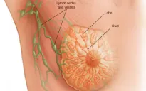 Đột phá về công nghệ nano thắp lên hy vọng điều trị ung thư vú ác tính