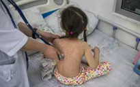 Dịch sởi nghiêm trọng nhất trong nhiều năm tại Mỹ