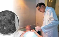 Nghệ An: Bệnh nhân 14 tuổi bị nhiễm trùng hoại tử do chữa bỏng bằng thuốc nam