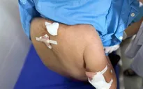 Cụ bà 77 tuổi bị đàn chó cắn, nhiều vết thương khắp cơ thể