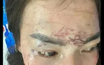 Khởi tố vụ án người phụ nữ bị tạt axit, xăm lên mặt do ghen tuông