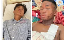 Nổ mìn tự chế khi đi đánh cá, hai thiếu niên bị thương nặng