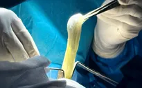 Vỡ túi ngực là gì?