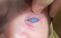 Hiếm gặp: Bé sơ sinh nghi mắc Glocom bẩm sinh sau 10 giờ chào đời