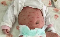 Bé sơ sinh 15 ngày tuổi nguy kịch vì thủy đậu biến chứng