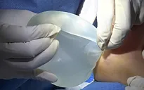 Tháo túi ngực cho phụ nữ có bệnh lý nền