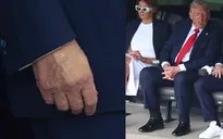 Nhà Trắng lên tiếng về căn bệnh mãn tính khiến ông Trump bị sưng chân và bầm tím tay