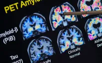 Thiếu hụt một nguyên tố quen thuộc có thể làm tăng nguy cơ Alzheimer