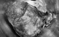 Ngỡ bụng béo, hóa ra khối u xơ tử cung nặng gần 3kg