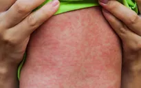 Canada báo cáo ca tử vong đầu tiên liên quan đến dịch sởi