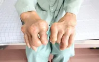 Tự điều trị gout, bị biến chứng nặng