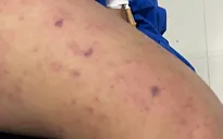 Bệnh não mô cầu xâm lấn: Khoảng 1/4 thanh thiếu niên có thể mang vi khuẩn mà không có triệu chứng