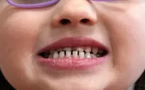 FDA siết chặt việc sử dụng thực phẩm bổ sung fluoride cho trẻ em