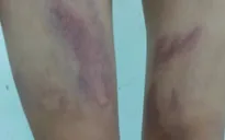 Khởi tố vụ án bạo hành bé gái 9 tuổi ở TP Hồ Chí Minh