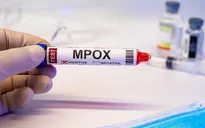 Mỹ phát hiện biến thể đậu mùa khỉ mới 