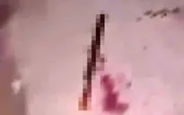 Nam thanh niên 17 tuổi ở Lâm Đồng bị chém đứt lìa bàn tay