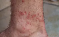 Mỹ ghi nhận ca tử vong đầu tiên liên quan đến dị ứng thịt đỏ do ve cắn