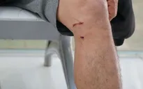 Tử vong do bệnh dại vẫn xảy ra: Khuyến cáo tiêm vaccine ngay khi bị chó cắn