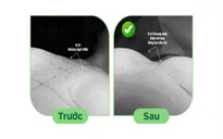 Kỹ thuật phẫu tích thuận lợi, khi tháo túi ngực và thay túi ngực mê mask thanh quản