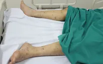 Hỏi - đáp về viêm màng não do não mô cầu