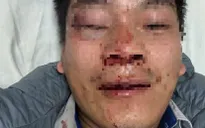 Lái xe buýt bị hành hung phải nhập viện cấp cứu