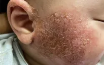 Cảnh báo các bệnh da liễu thường gặp khi thời tiết lạnh