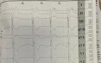 Hội chứng Kearns-Sayre - bệnh di truyền hiếm đe dọa tim mạch ở người trẻ