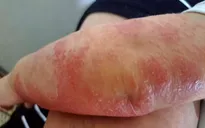 Viêm da cơ địa mùa lạnh: Không chủ quan và tự ý điều trị
