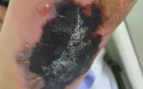 Ghép da điều trị hoại tử da ngay tại tuyến cơ sở