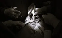 Đi khám vì nuốt vướng, phát hiện mắc ung thư tuyến giáp