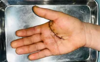 Giữ lại chức năng vận động bàn tay bị dao cắt cho bệnh nhân