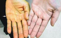 Suy gan cấp vì tự ý dùng thuốc nam không rõ nguồn gốc