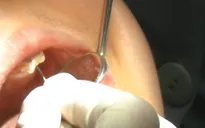 Từ một chiếc răng sâu, bệnh nhân đối mặt biến chứng hoại tử ngực nguy hiểm