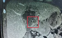 Ca bệnh hiếm gặp: Nội soi lấy dị vật kim loại trong gan