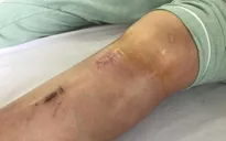 Dọn nhà đón Tết, phòng ngừa chấn thương khớp