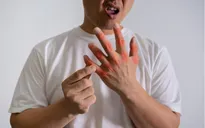 3 bệnh lý chuyển hóa thường gặp sau Tết