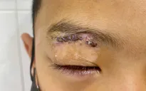 Nhiều trẻ chấn thương mắt do pháo dịp Tết