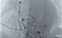 Cấp cứu kịp thời bệnh nhân rối loạn nhịp tim nguy kịch