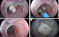 Liên tiếp 3 ca nuốt dị vật nguy hiểm dịp Tết