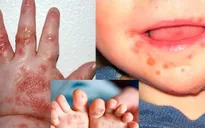 Tay chân miệng vào mùa: Trẻ có thể mắc nhiều lần, dễ chuyển nặng nếu chủ quan