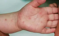 Hà Nội: Số ca mắc tay chân miệng tăng, nhiều dịch bệnh xuất hiện rải rác