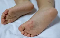 Những sai lầm trong điều trị tay chân miệng cho trẻ