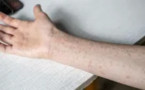 Xuất hiện ổ lây nhiễm sởi tại Singapore