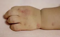 Bệnh tay chân miệng lây lan trong trường học, cha mẹ cần làm gì?