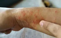 Số ca tử vong tăng, Thái Lan cảnh báo bùng phát dịch “sốt đất” nguy hiểm